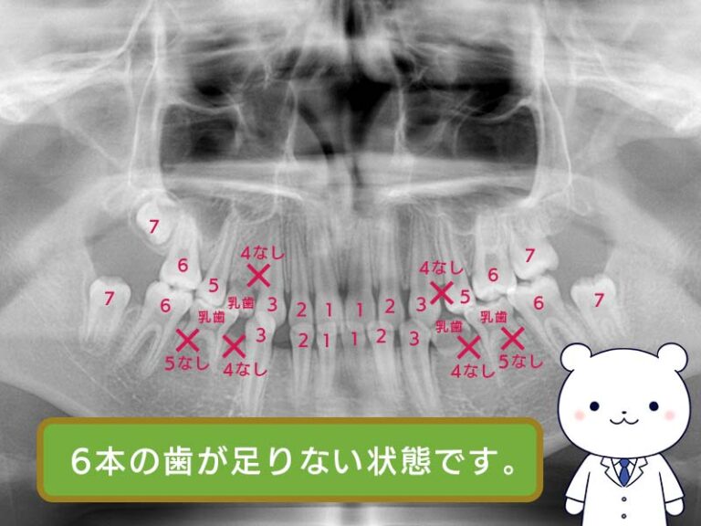 先天欠如歯の症状