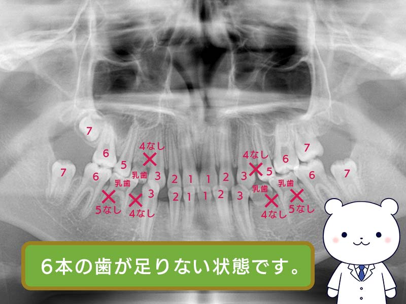 先天欠如歯の症状