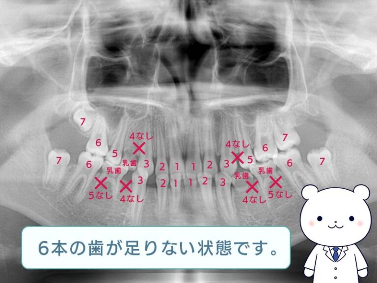 6本の歯が足りない状態