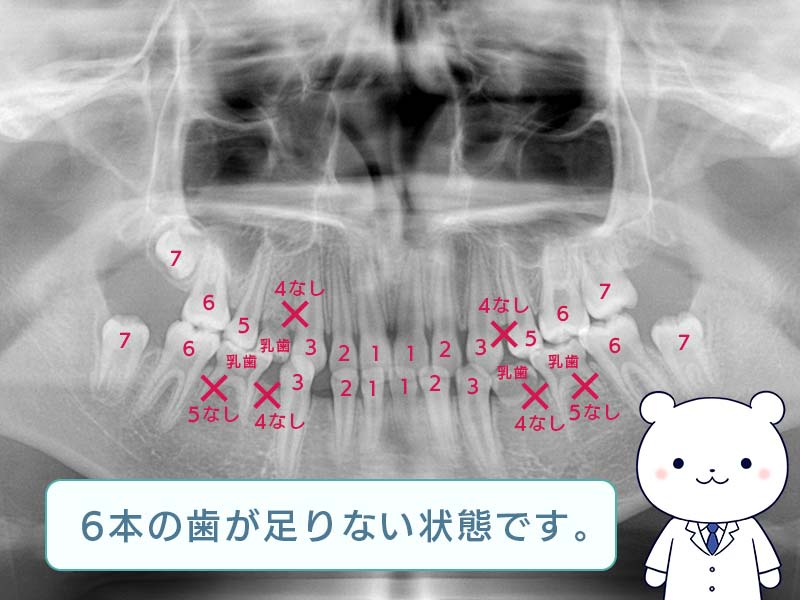 6本の歯が足りない状態