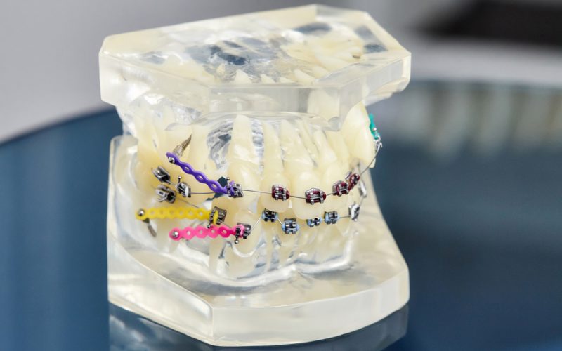 Human jaw or teeth orthodontic dental model with implants, dental braces