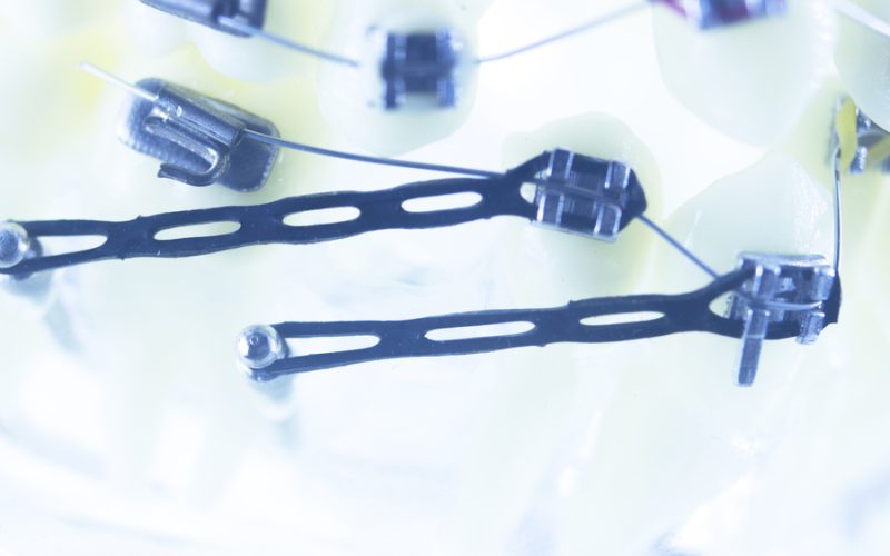 Orthodontics dentists teaching model dental teeth plastic and metal brackets aligners to straighten each tooth.