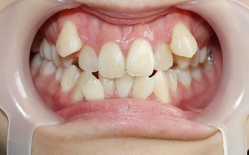 double-teeth1 double-teeth1