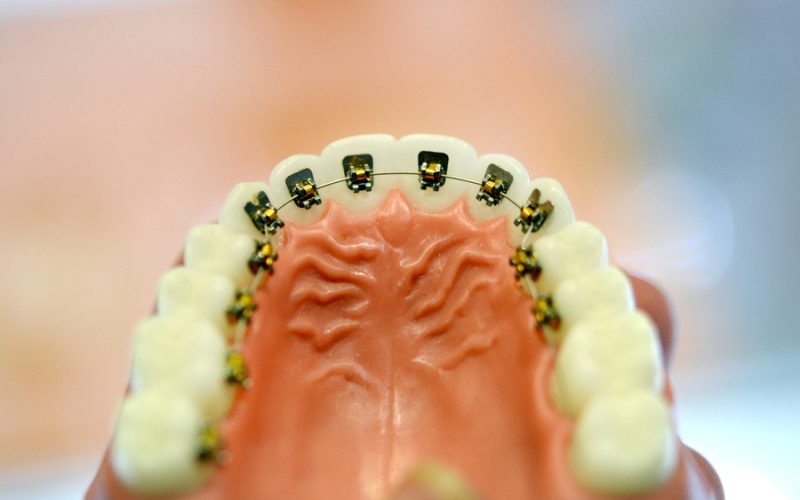 Braces on the model of the lower human teeth, dental tooth dentistry close-up