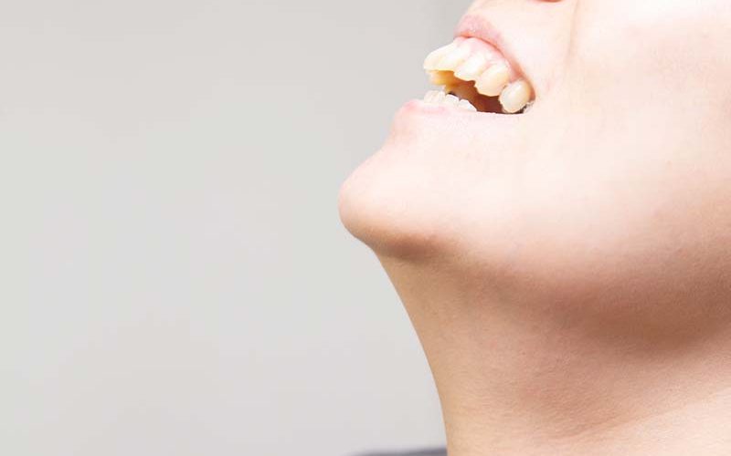 overbite2