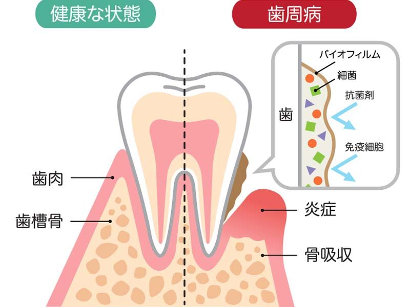 periodontal-disease