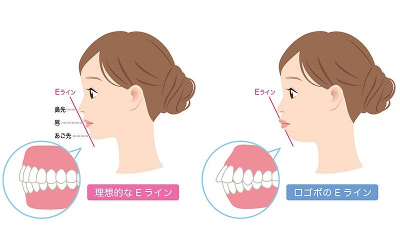 underbite1